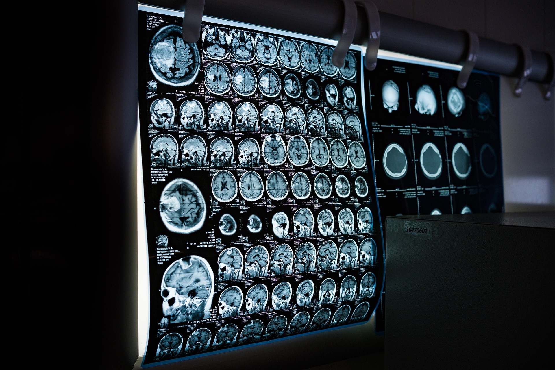Photo of CT scans on a computer screen